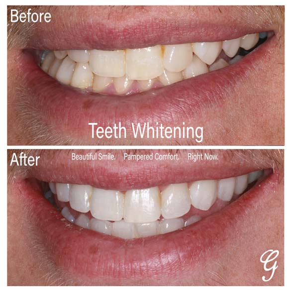 Teeth Whitening Payson UT - In-office Whitening - Take-home Trays