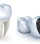 What to expect from Preparation to Placement of Porcelain Dental Crowns