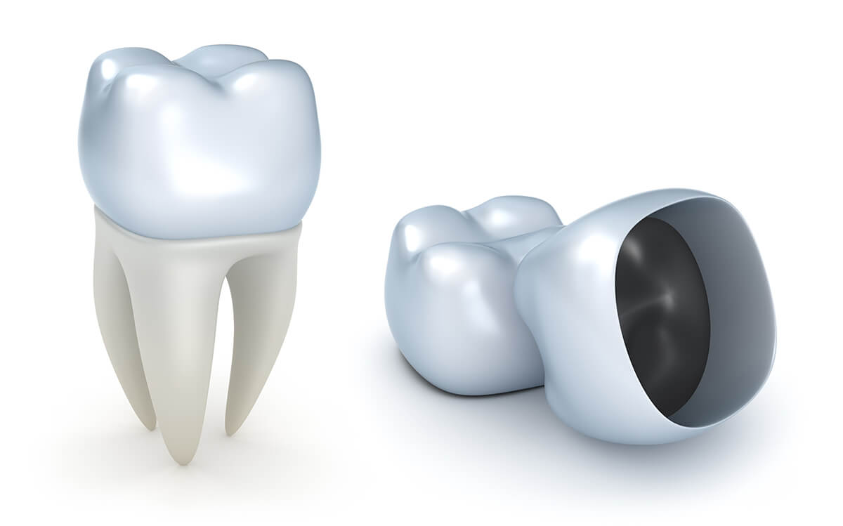 Dental Crowns Service in Payson UT Area