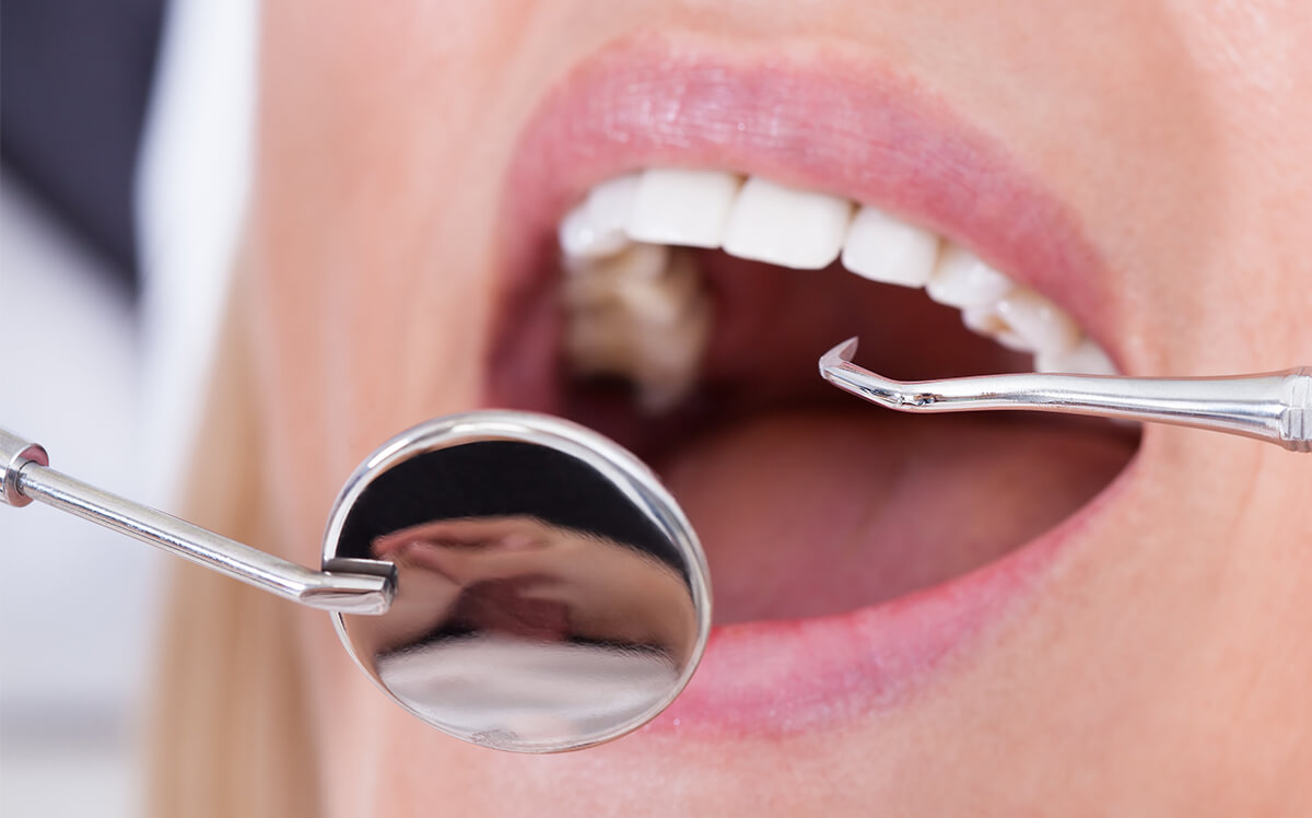 Teeth Cleaning Service in Payson UT Area