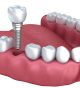 Missing Teeth? Experience the Life-Changing Benefits of Dental Implants