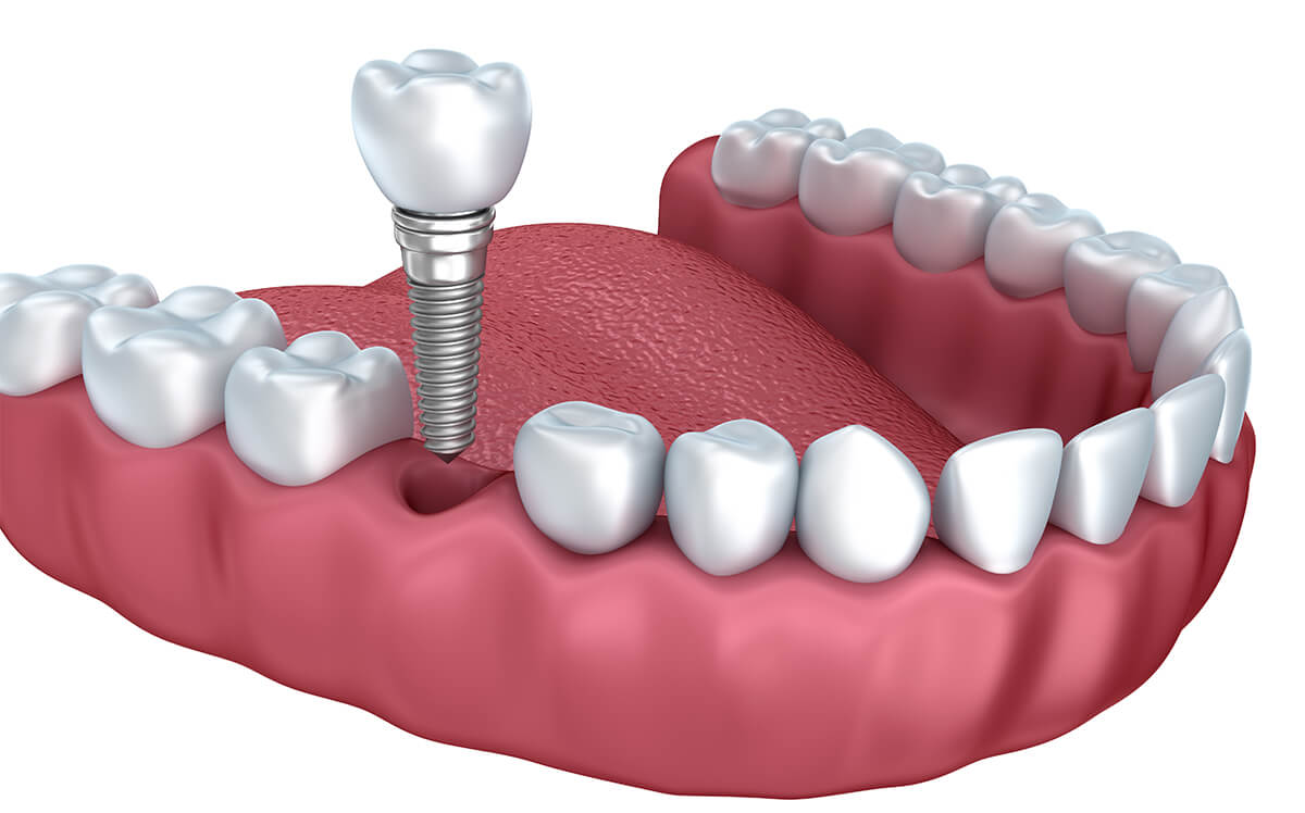 Teeth Implants Near Me Payson UT Area