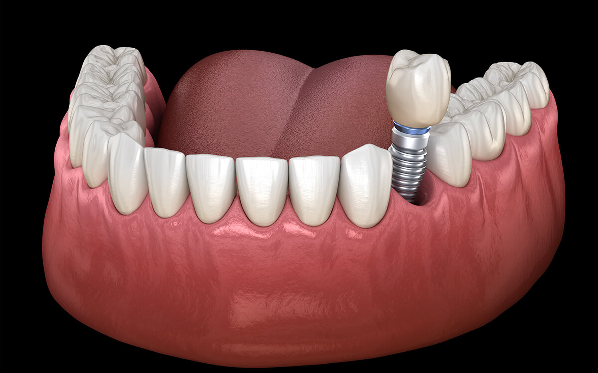 What Specialist is Best for Dental Implants in Payson Area