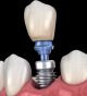 Your Complete Smile Awaits with a Dentist That Installs Natural-looking Dental Implants