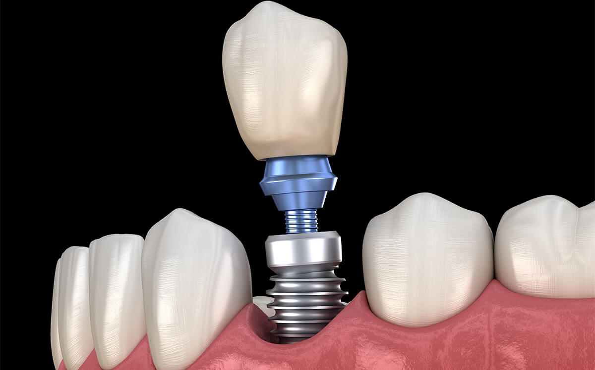 Dentist That Do Implants in Payson UT Area