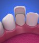 How Porcelain Dental Veneers Can Benefit Your Smile